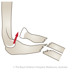 ED_Section 1_BADO FRACTURE TYPE 4.jpg